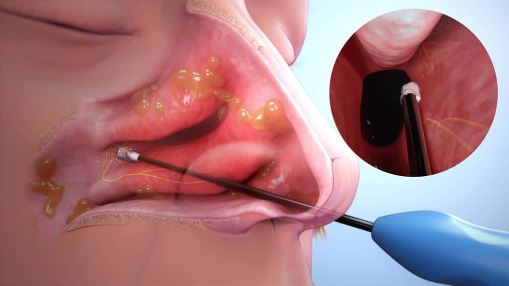 Chronic rhinitis profile view rendering
