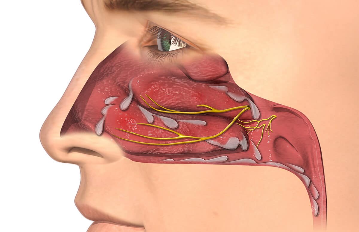 Rhinitis Patient Lateral View Illustration